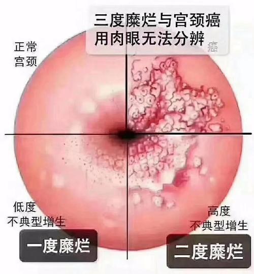 都说宫颈糜烂不是病是不是就不用治了有一种情况需要尽早治