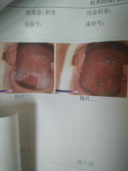 都说宫颈糜烂不是病是不是就不用治了有一种情况需要尽早治