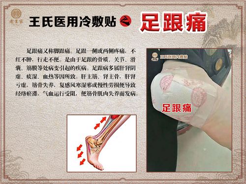 治疗骨刺的良方横扫颈椎病腰腿关节痛足跟痛