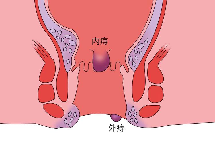 痔疮初期图片_痔疮初期图片真实图片