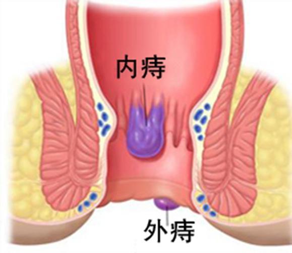 痔疮初期症状_痔疮初期症状是什么