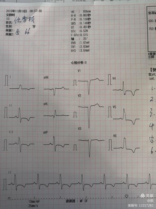 异常心电图_异常心电图是什么意思