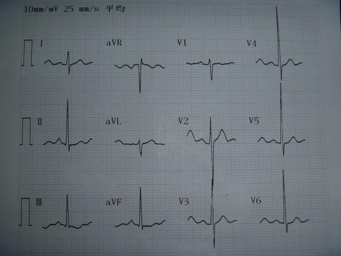 异常心电图_异常心电图是什么意思