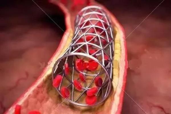 冠脉支架进入千元时代_冠脉支架进入千元时代对医生的影响