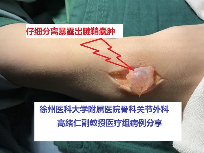 腱_腱鞘囊肿怎么治疗 手腕