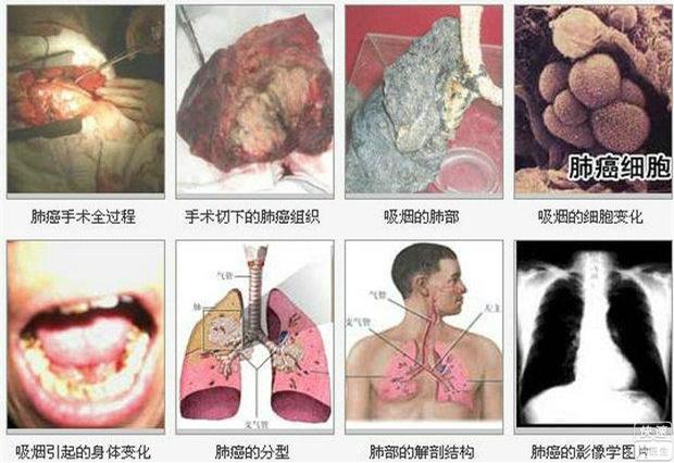 肺癌的早期症状图片_肺癌的早期症状图片大全