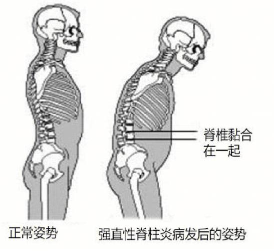 强直性脊柱炎的治疗方法_强直性脊柱炎的治疗方法中哪项不正确