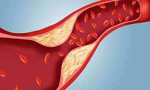 血管硬化_血管硬化怎么治最好的方法