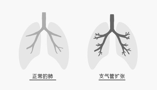 什么是支气管扩张_什么是支气管扩张最常见的症状