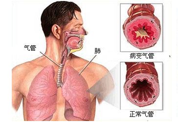 什么是支气管扩张_什么是支气管扩张最常见的症状