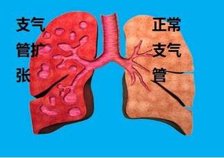 什么是支气管扩张_什么是支气管扩张最常见的症状