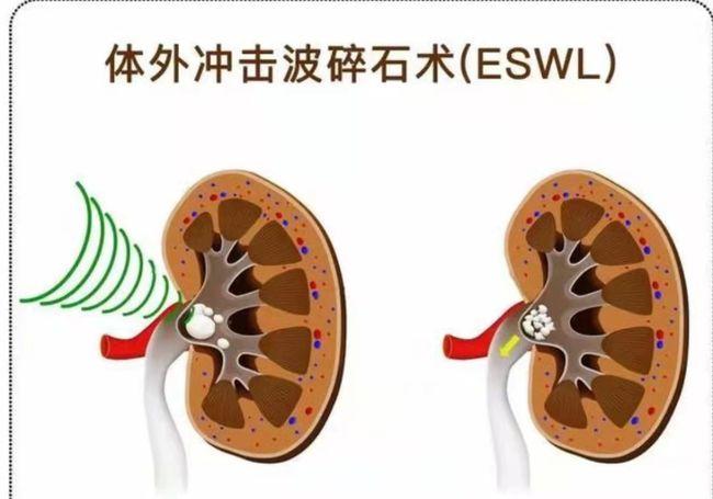 尿结石最佳治疗方法_尿结石最佳治疗方法碎石