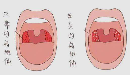 扁桃体发炎最快治愈法_急性扁桃体发炎最快治愈法