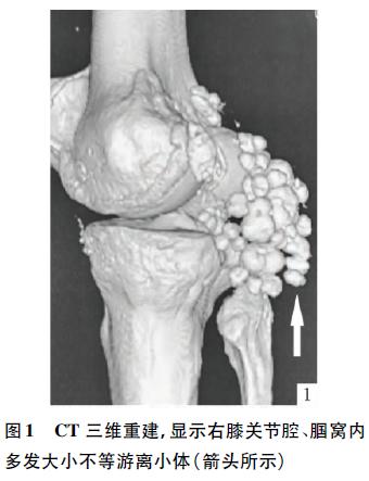 软骨瘤_软骨瘤严重吗