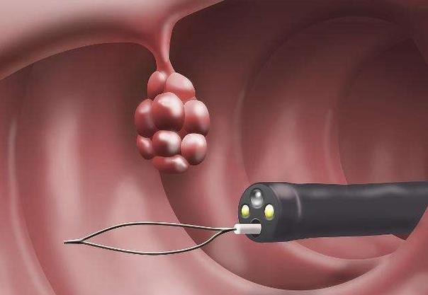 直肠息肉_直肠息肉的症状及危害