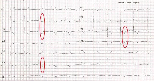 心电图异常_心电图异常是什么原因