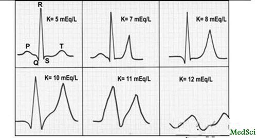 高钾血症心电图_高钾血症心电图表现
