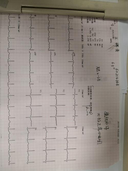 大致正常心电图_大致正常心电图什么意思