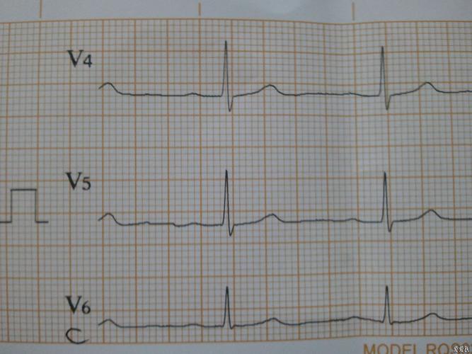 大致正常心电图_大致正常心电图什么意思