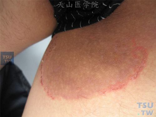 大腿肚内侧股癣_大腿肚内侧股癣图片怎么治