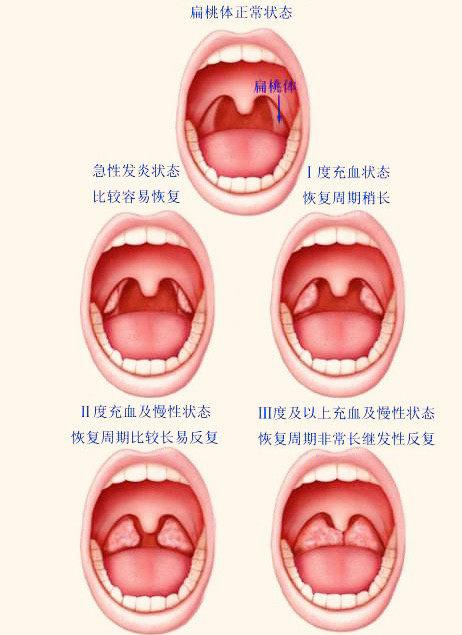 扁桃体炎症状_扁桃体炎症状有哪些表现