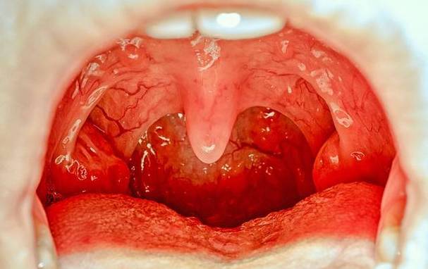 扁桃体炎症状_扁桃体炎症状有哪些表现