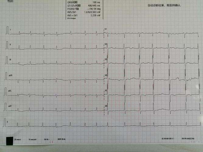 心房颤动心电图_心房颤动心电图特征