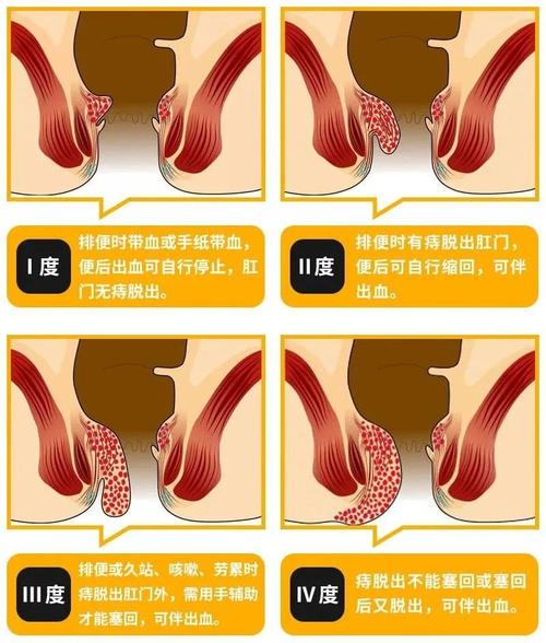 内痔疮图片_内痔疮图片真实图片