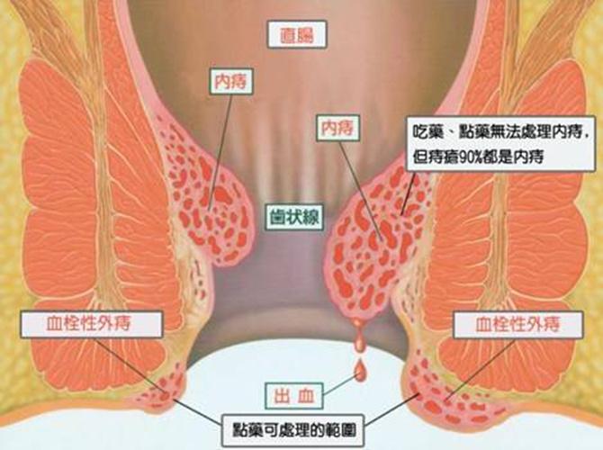 内痔疮图片_内痔疮图片真实图片