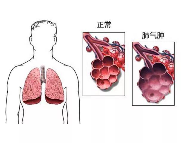 老年人肺气肿_老年人肺气肿是什么病严重吗