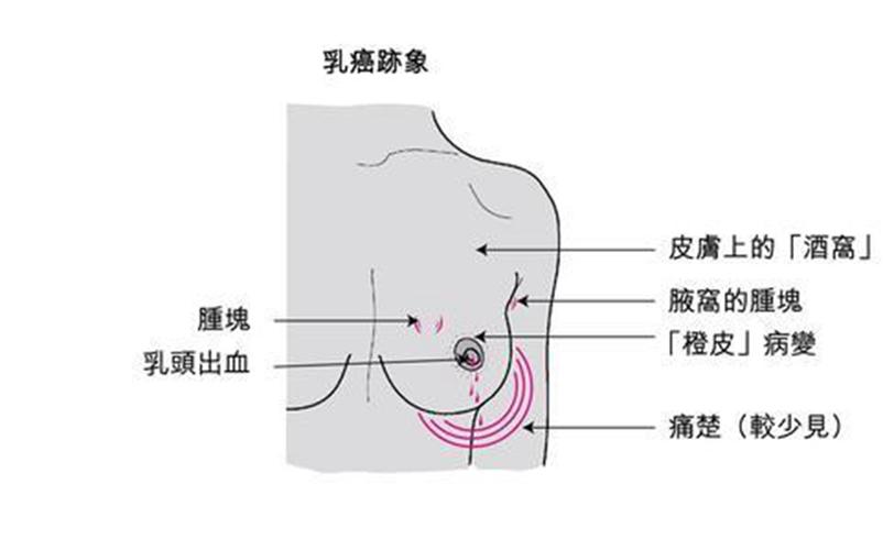 乳腺癌的早期症状图_乳腺癌的早期症状图片是什么样子