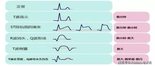 心电图t波改变_心电图t波改变说明什么问题