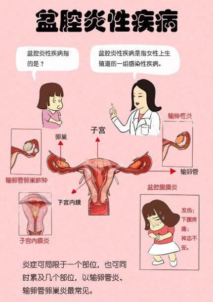 盆腔炎的症状_盆腔炎的症状有哪些症状