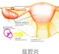 盆腔炎的症状_盆腔炎的症状有哪些症状