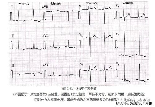 心电图 t波改变_心电图t波改变说明什么