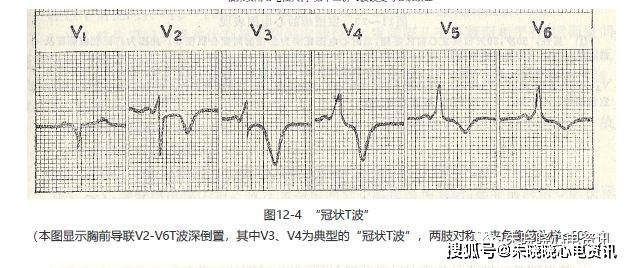 心电图 t波改变_心电图t波改变说明什么