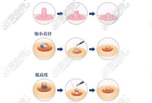 乳晕大怎么办_乳晕大怎么办一颗颗的是什么做乳晕缩小手术要休息多久