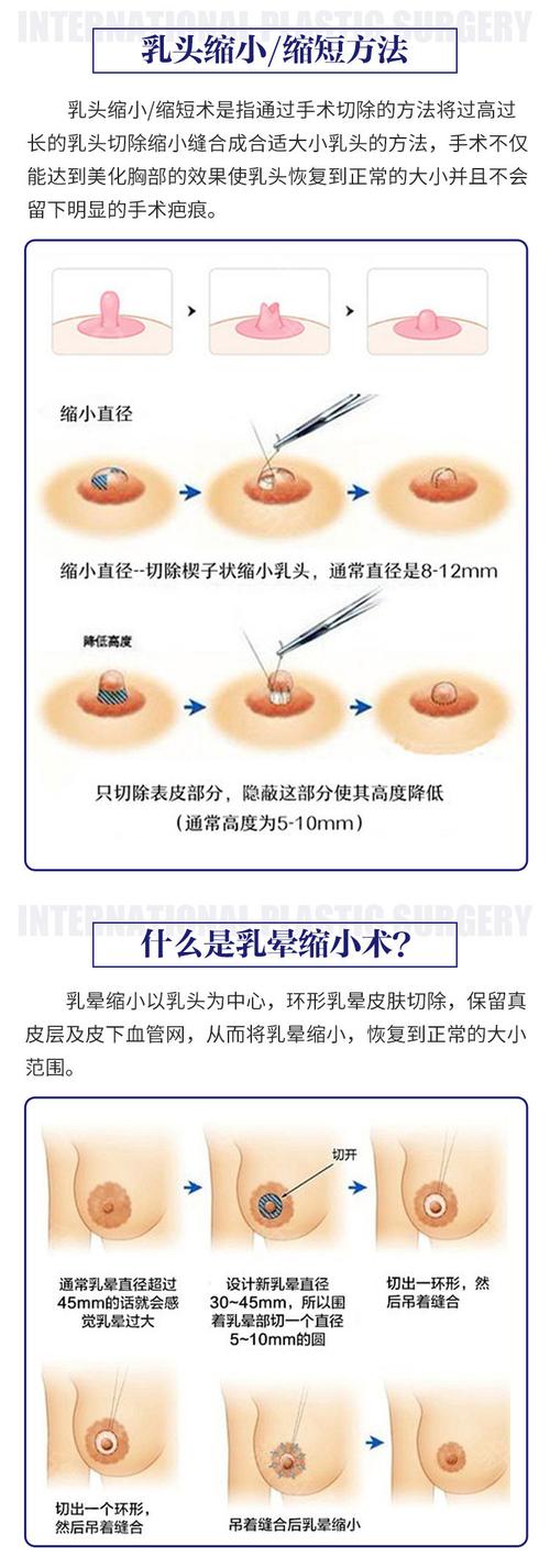 乳晕大怎么办_乳晕大怎么办一颗颗的是什么做乳晕缩小手术要休息多久