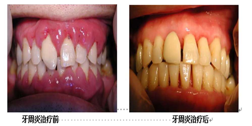 牙周炎的症状表现_牙周炎的症状表现怎么治疗