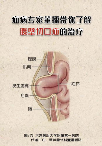 切口疝_切口疝最佳治疗方法