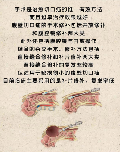 切口疝_切口疝最佳治疗方法