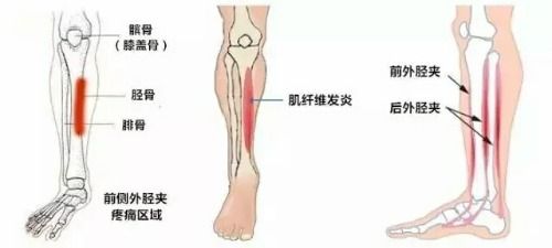 骨膜炎怎么治_骨膜炎怎么治疗才能彻底根除