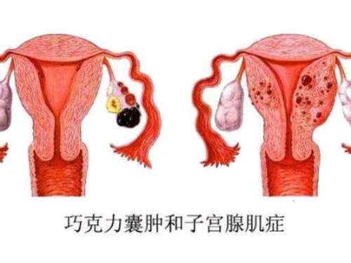 卵巢巧克力囊肿能怀孕吗_卵巢巧克力囊肿能怀孕吗女性