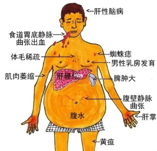 肝硬化早期症状_肝硬化早期症状能治好吗能活几年