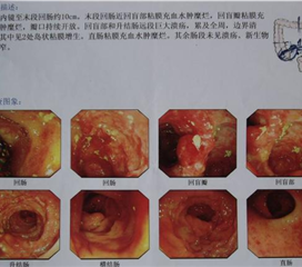 肠系膜淋巴结结核_肠系膜淋巴结结核症状