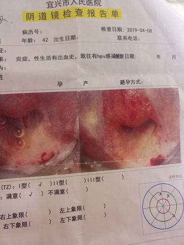 宫颈口有小硬疙瘩图片_宫颈口有小硬疙瘩图片 图片欣赏