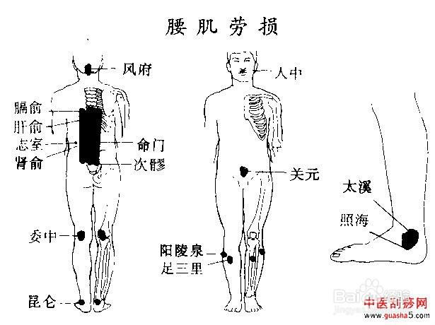 腰肌劳损怎么办_男人腰肌劳损怎么办