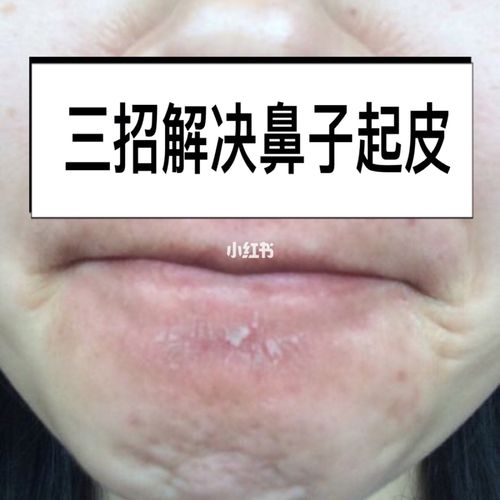 鼻子干_鼻子干燥是什么原因