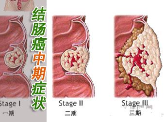 结肠癌的早中晚期的症状和表现_结肠癌的早中晚期的症状和表现是什么