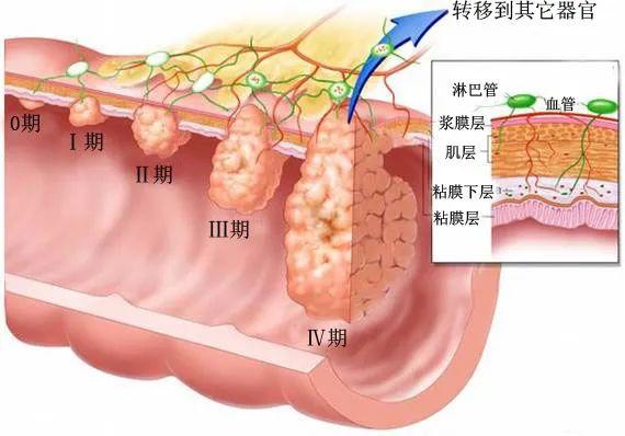 结肠癌的早中晚期的症状和表现_结肠癌的早中晚期的症状和表现是什么